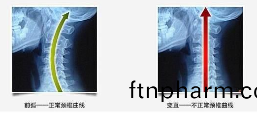 頸椎(chui)生(sheng)理麯度(du)變(bian)直’